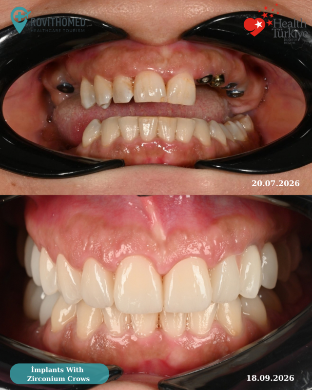 Dental implants with zirconium crowns in Turkey – before and after