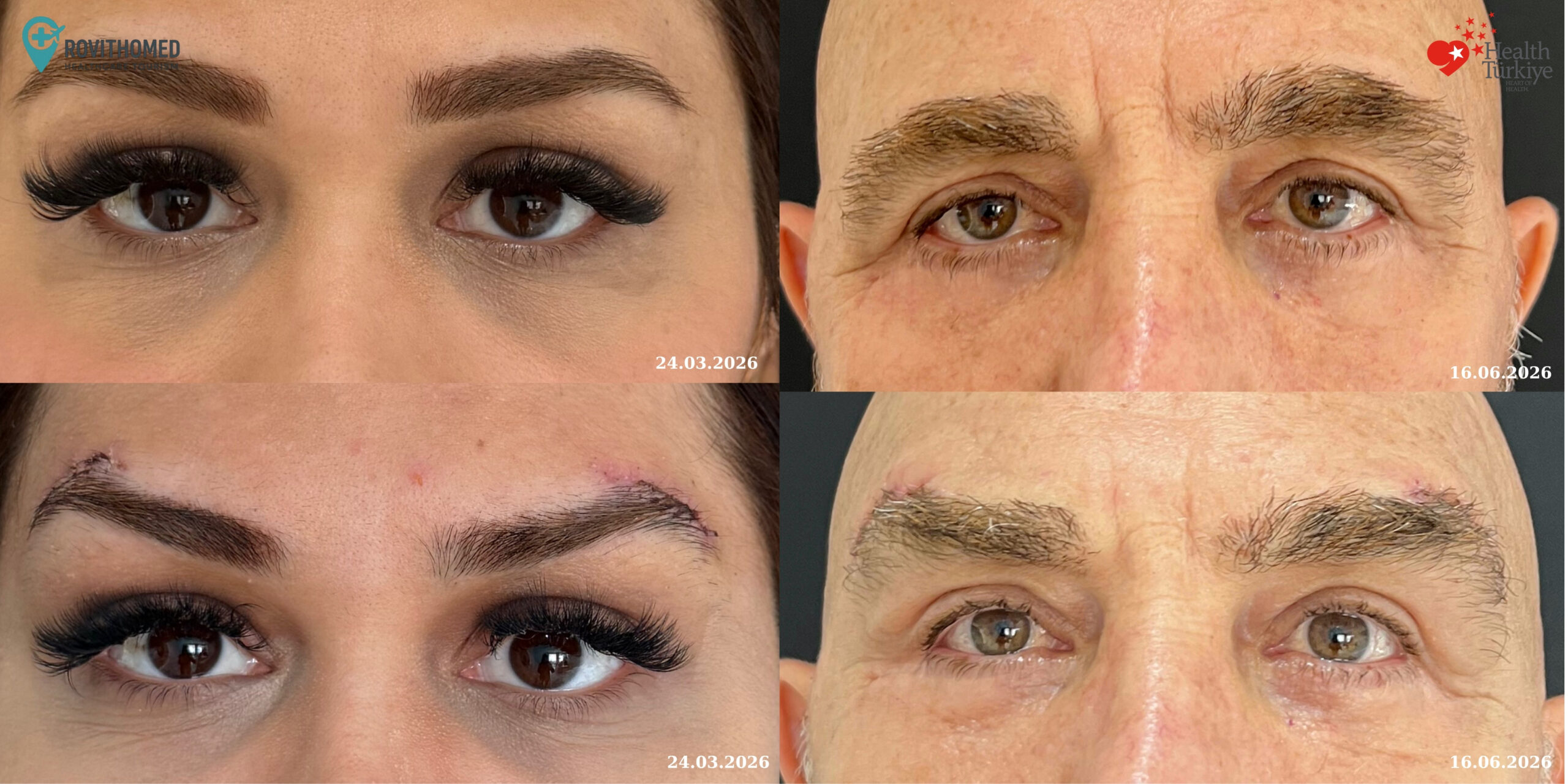 direct brow lift just after the surgery