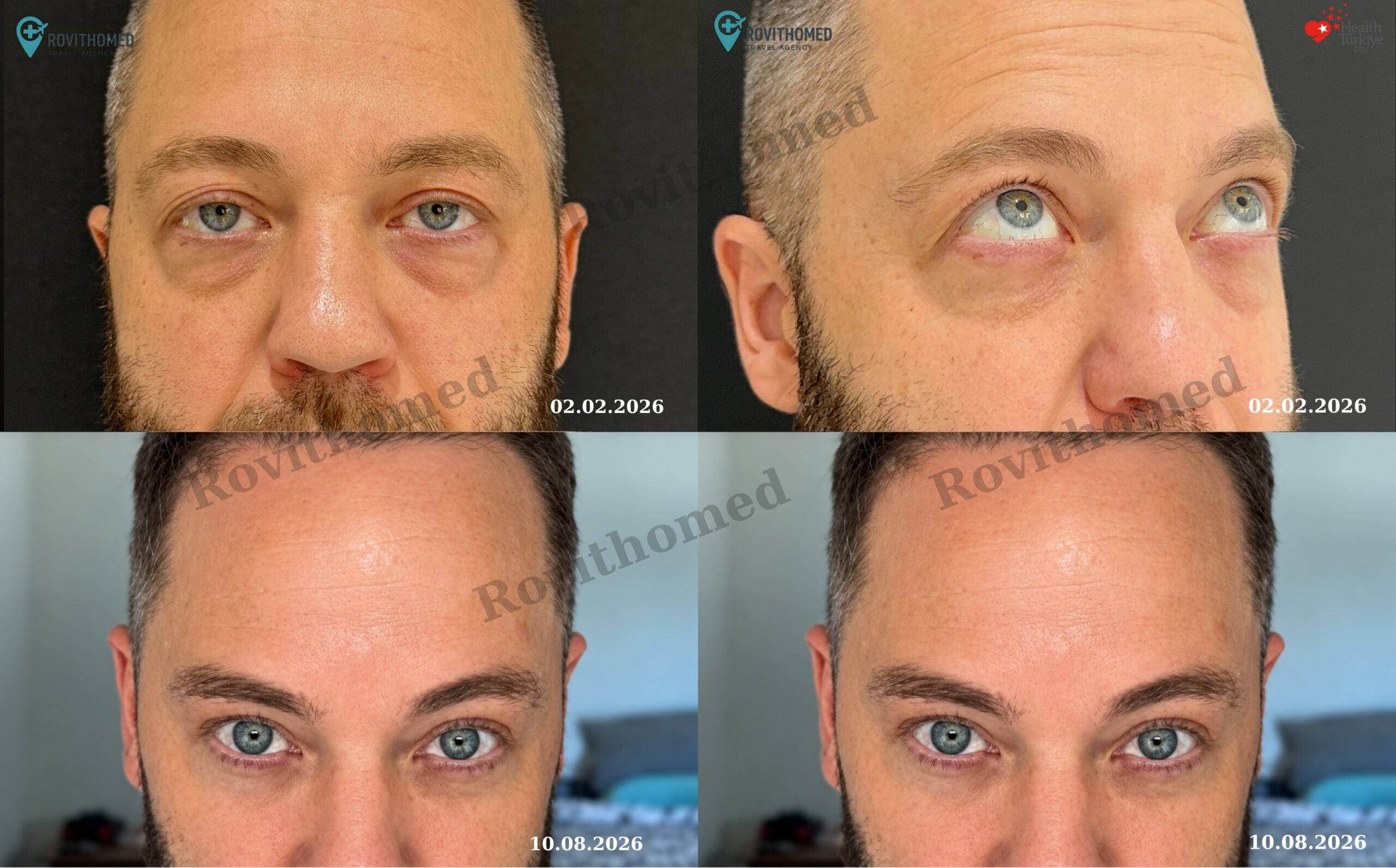 Hunter Eye Surgery before and after results in Turkey