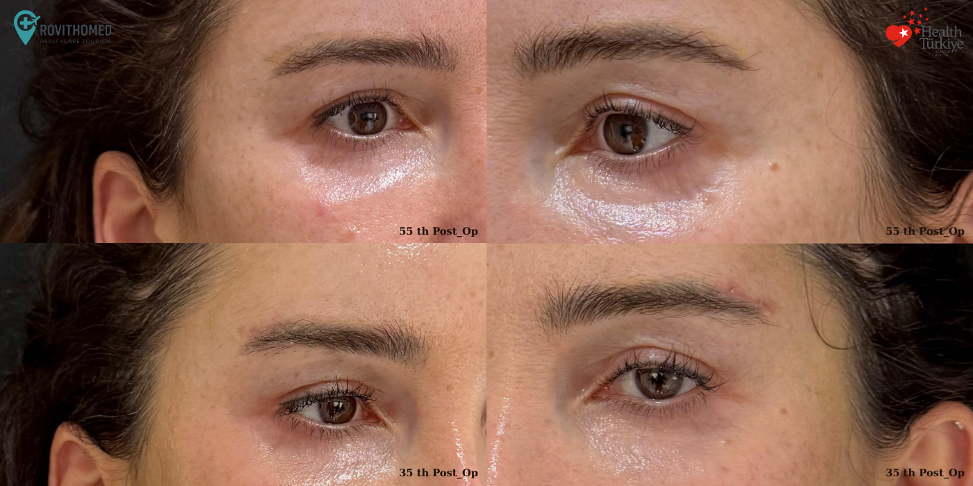 Direct brow lift scars before and after surgery